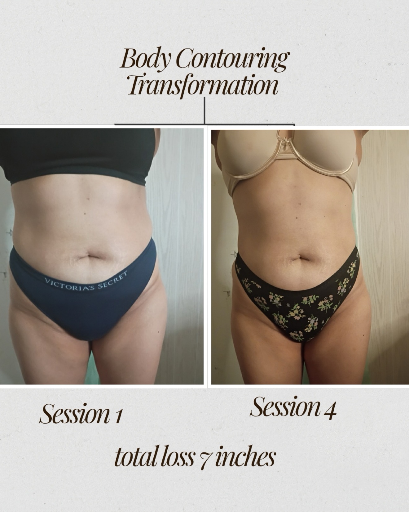 Real client RF body contouring before and after, Session 1 to Session 4